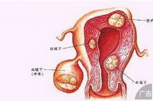 女性患了子宫性不孕怎么办
