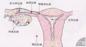 治疗输卵管肿瘤医院哪家比较好