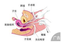 免疫性不孕