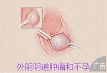 外阴肿瘤