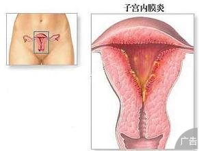 治疗子宫内膜炎的费用需要多少