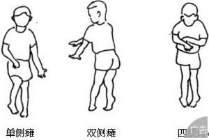 小儿脑瘫的危害有哪些呢