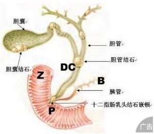 治疗胆囊炎选择中山国丹中医院