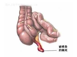 阑尾炎